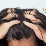 Penyebab Kutu Rambut