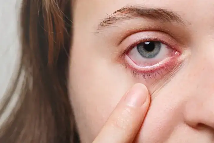 Cara Menyembuhkan Sakit Mata